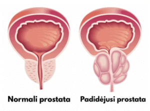 Prostatos kompleksas prostatai